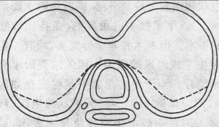 3.4 甲狀腺大部切除術(shù)
